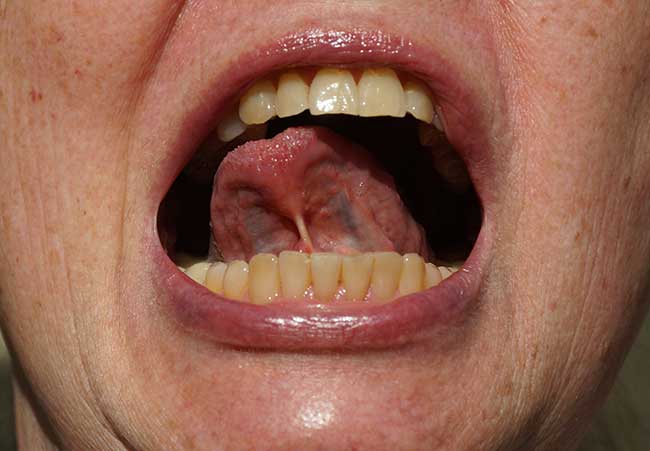tongue-tie-in-adults