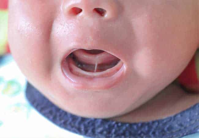 tongue-tie-in-babies